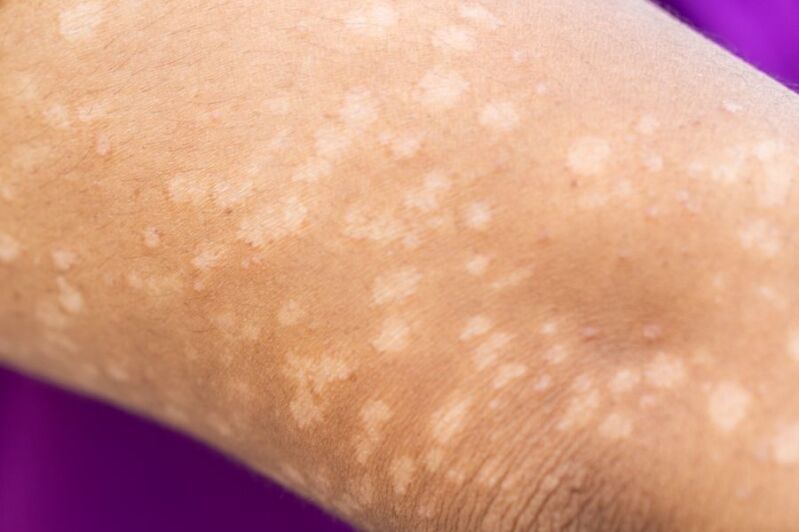 Lupus Misdiagnosis attorney