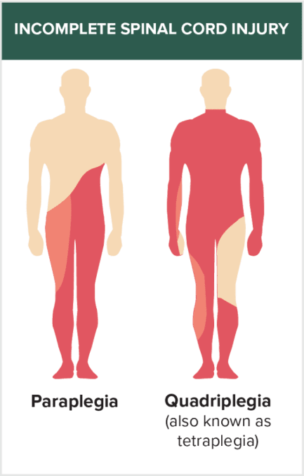 incomplete spinal injury