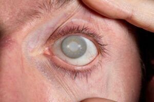 A close-up of a person's eye with a severe cataract, possibly caused by eye doctor malpractice. This image highlights the risks of misdiagnosis or surgical errors leading to vision impairment.