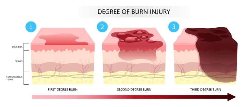 degree-of-burn-injuries