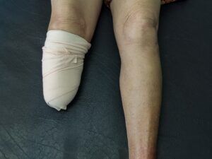 amputation injury attorney in Chicago