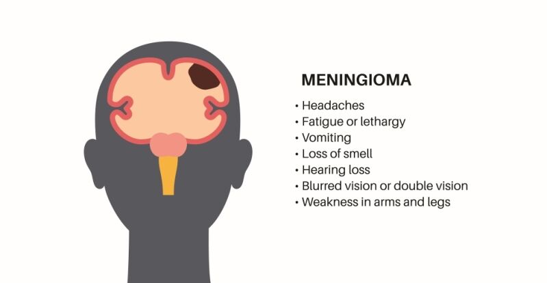 meningioma brain tumor symptoms