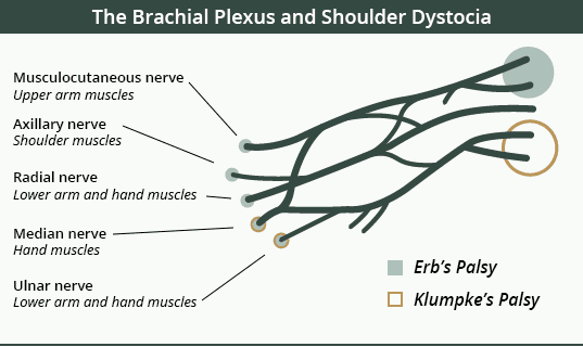 brachial plexus and shoulder dystocia